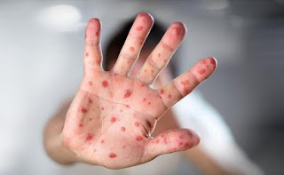 MORBILE U BiH – SVE VIŠE DJECE HOSPITALIZOVANO, NEKOLIKO NA RESPIRATORIMA